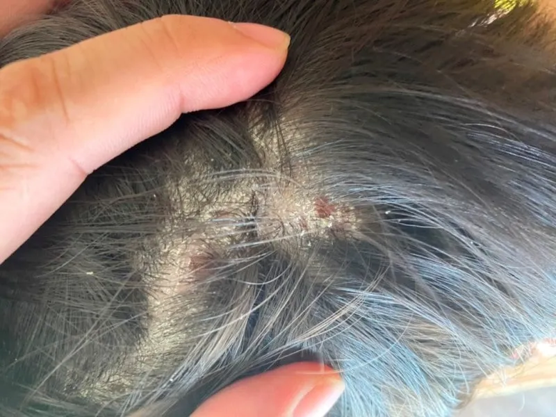Bệnh lý về da đầu có thể khiến tóc thưa dần